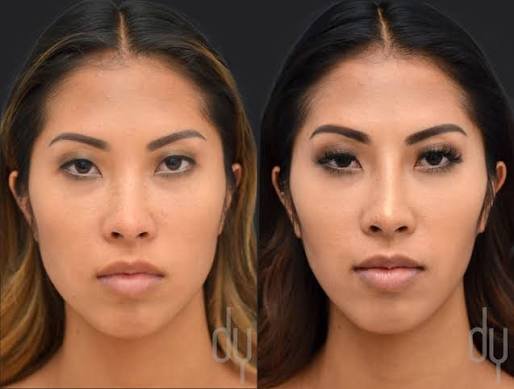 Masseter Botox in Malaysia: A Non-Surgical Path to a Slimmer Jawline