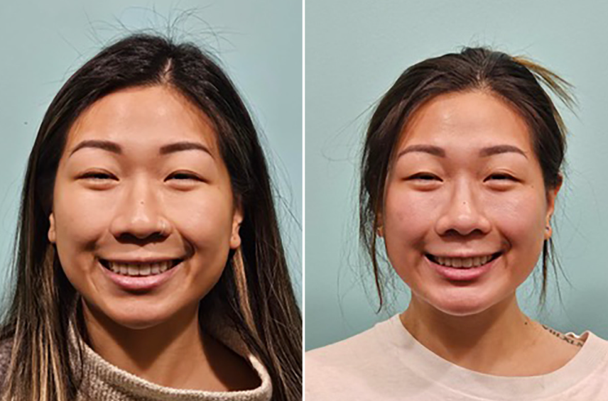 Individualised Considerations in Asian Rhinoplasty